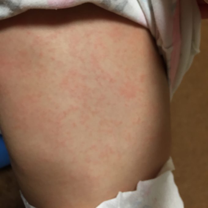 背中 湿疹 赤い お腹 赤ちゃん 赤ちゃんをお風呂に入れると湿疹が背中やお腹に出るけど痒くない場合は放っておいてもいいの？